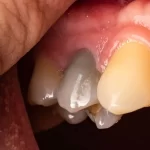 Digital Smile Design: Shaping the Future of Smile Makeovers