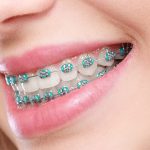 The Journey to a Perfect Smile: What to Expect from Your Implant Dentist