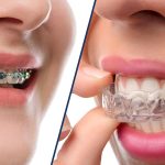Clear Aligners vs. Invisalign: What’s the Real Difference?
